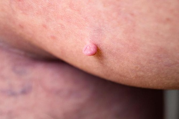 Mụn thịt (Skin tags )là gì? chúng có nguy hiểm không cách loại bỏ mụn thịt